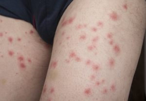 Bed bug bites on a male leg